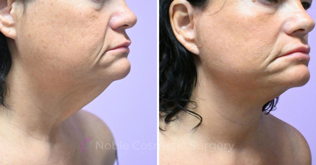 Case--5722 | Before and After Facelift 4