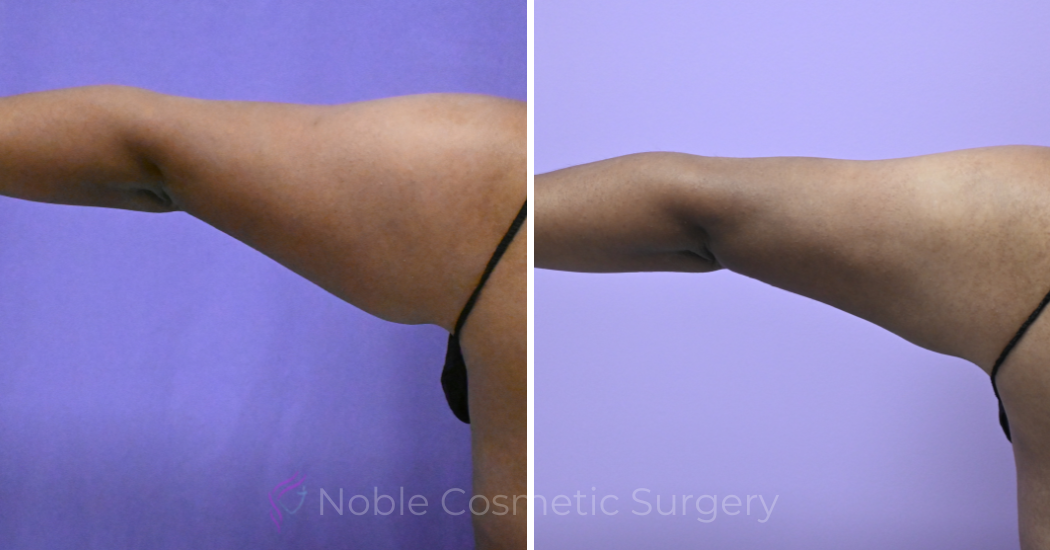Case--20274 | Before and After Arm Liposuction 2