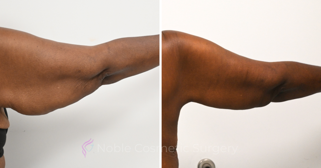 Case--20391 | Before and After Brachioplasty 4