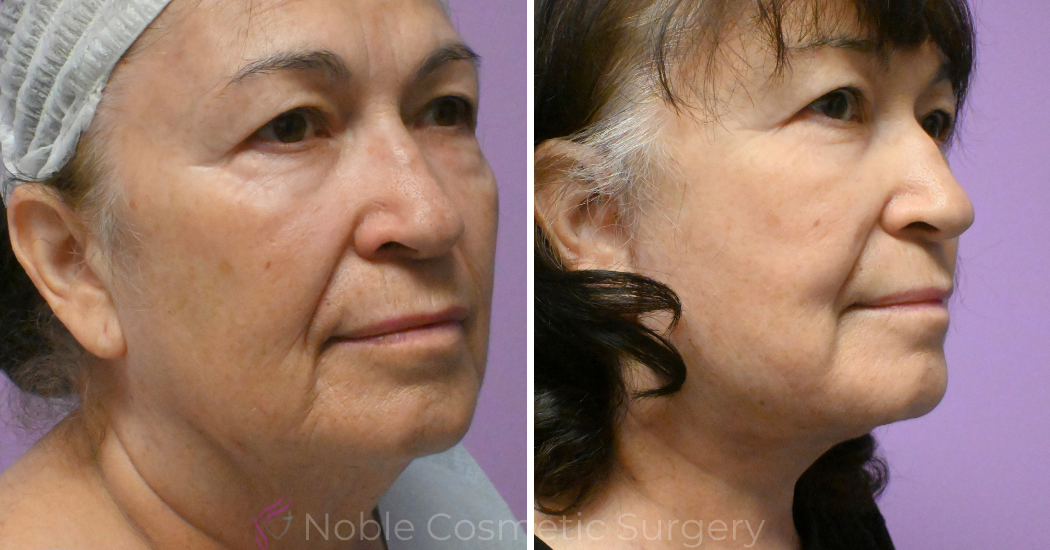 Case--20618 | Before and After Facelift 3