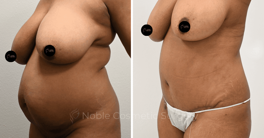 TUMMY-TUCK-CASE-14407 | Before and After Abdominoplasty 3