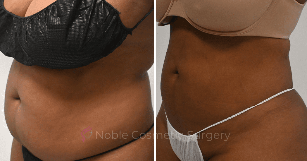 LIPOSUCTION-CASE-10271 | Before and After Liposuction 4