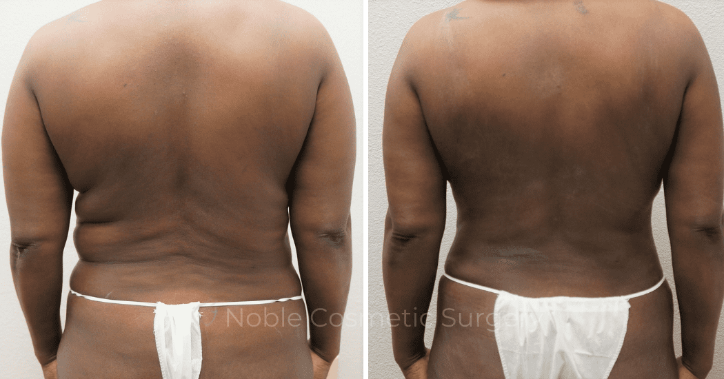 MOMMY-MAKEOVER-CASE-00305 | Before and After Mommy Makeover 3