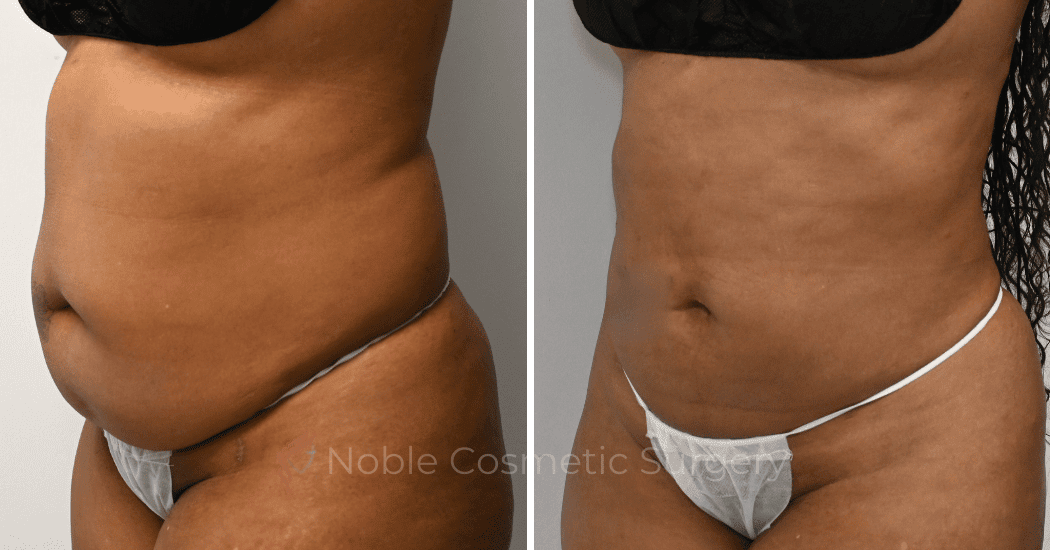 LIPOSUCTION-CASE-10929 | Before and After Liposuction 4