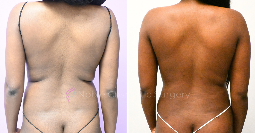 Case--20347 | Before and After Abdominoplasty 4