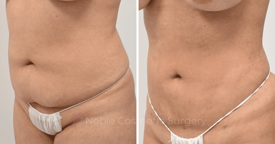 LIPOSUCTION-CASE-12977 | Before and After Liposuction 4