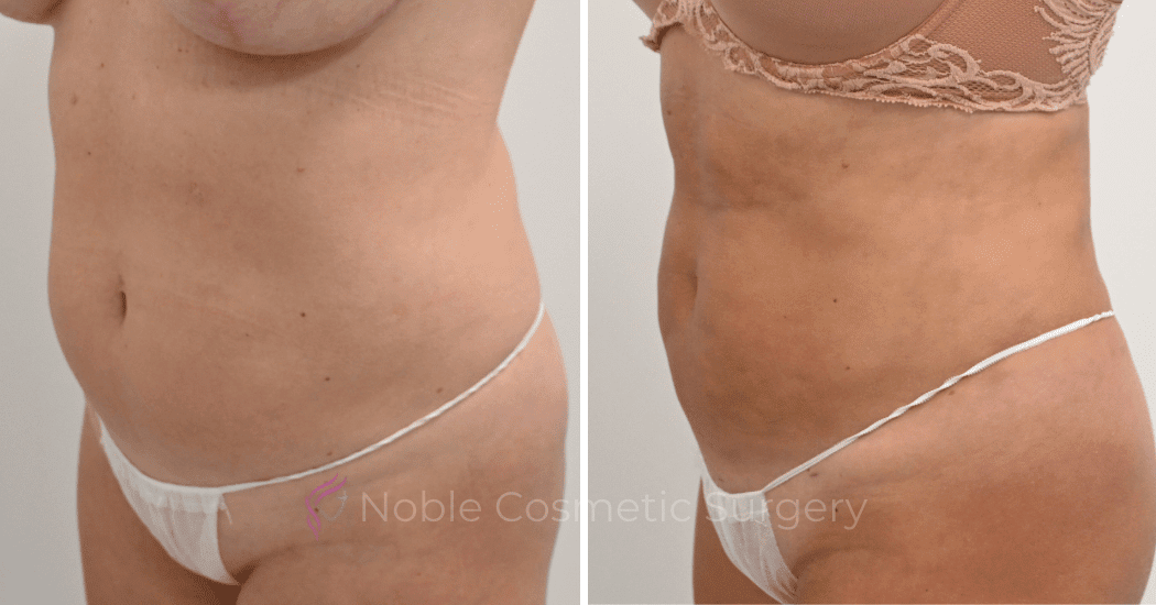 LIPOSUCTION-CASE-13006 | Before and After Liposuction 4