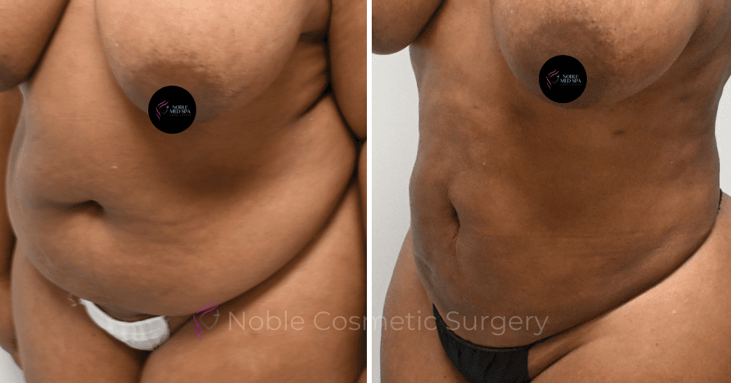 LIPOSUCTION-CASE-13371 | Before and After Liposuction 4
