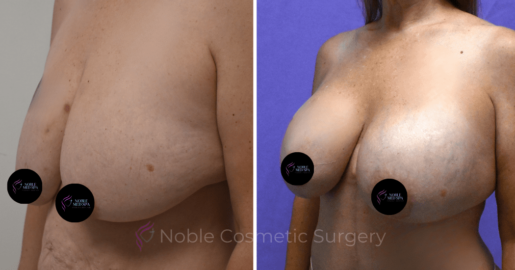 BREAST-AUGMENTATION-WITH-LIFT-CASE-10275 | Before and After Breast Augmentation with Lift 3
