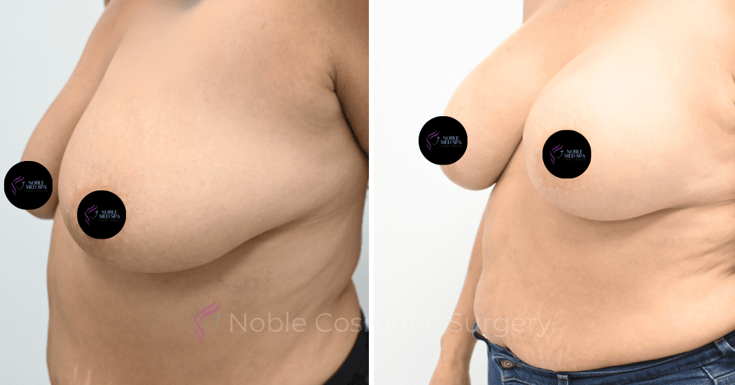 BREAST-AUGMENTATION-CASE-12478 | Before and After Breast Augmentation 3