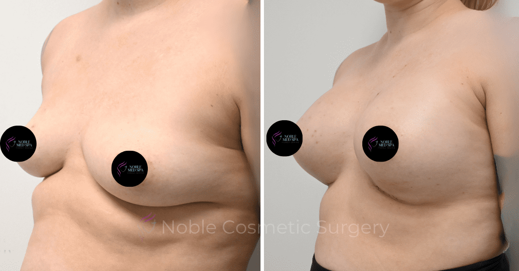 BREAST-AUGMENTATION-CASE-11771 | Before and After Breast Augmentation 2