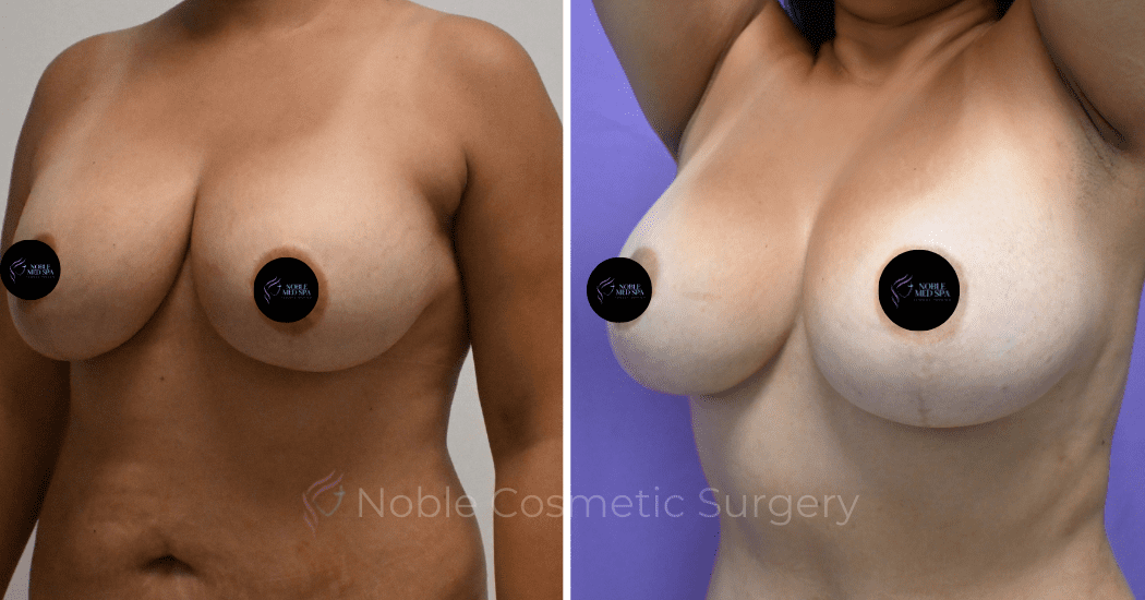 BREAST-AUGMENTATION--CASE-00310 | Before and After Breast Augmentation 4