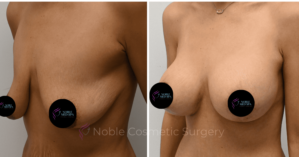 BREAST-AUGMENTATION-WITH-LIFT-CASE-10931 | Before and After Breast Augmentation with Lift 4
