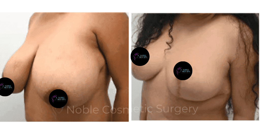 BREAST-REDUCTION-CASE-19221 | Before and After Breast Reduction 2
