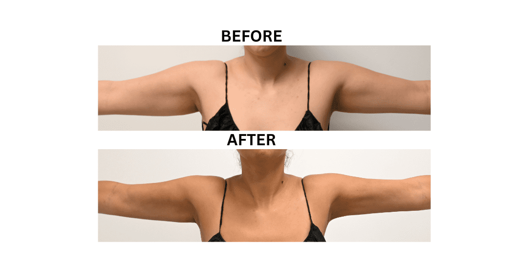 LIPOSUCTION-ARMS-CASE-00316 | Before and After Arm Liposuction 3