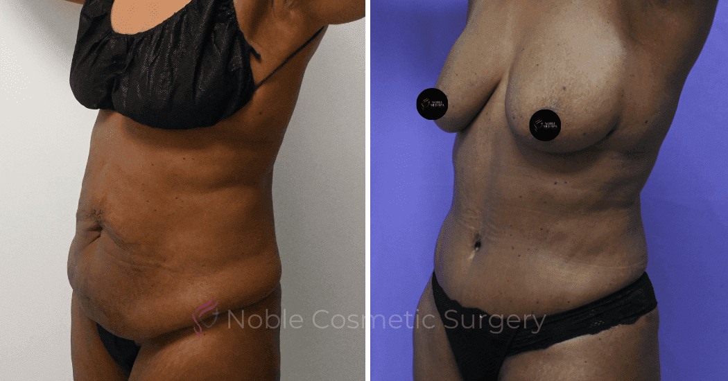 TUMMY-TUCK-CASE-10375 | Before and After Abdominoplasty 4