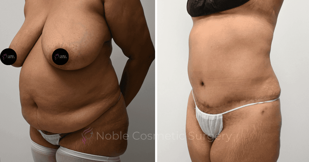 TUMMY-TUCK-CASE-11110 | Before and After Abdominoplasty 4
