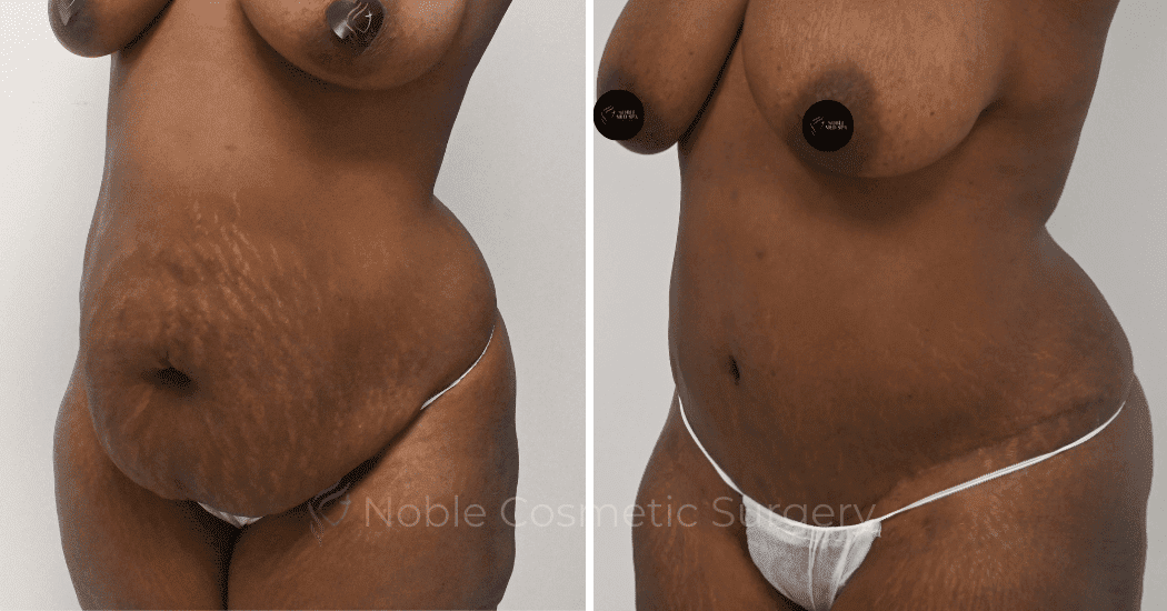 TUMMY-TUCK-CASE-10563 | Before and After Abdominoplasty 4