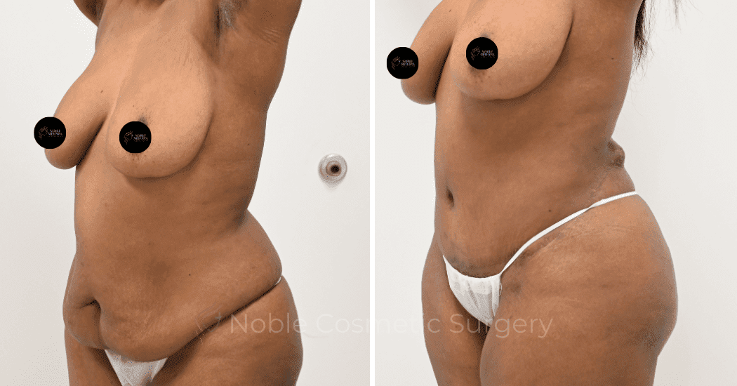 TUMMY-TUCK-CASE-13171 | Before and After Abdominoplasty 4