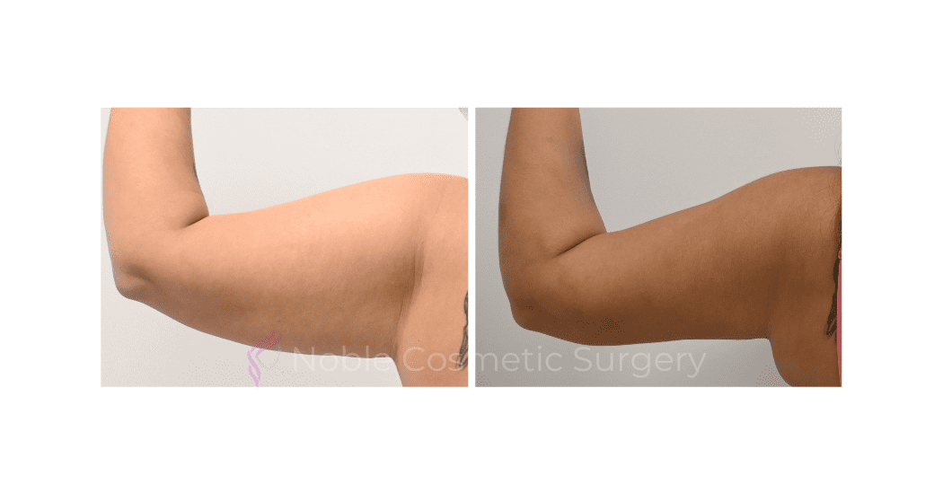 ARM-LIFT-CASE-15380 | Before and After Brachioplasty 4