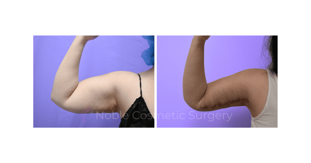 ARM-LIFT-CASE-19182 | Before and After Brachioplasty 5
