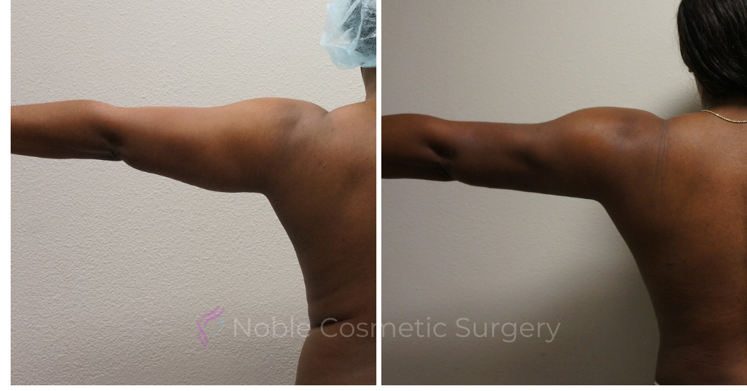 LIPOSUCTION-ARMS-CASE-00500 | Before and After Arm Liposuction 4