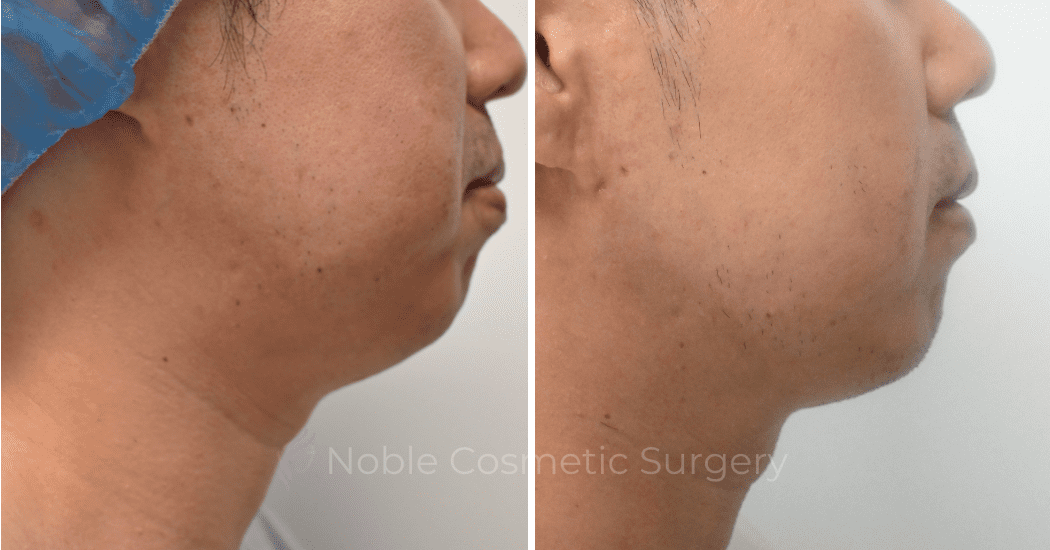SUBMENTAL-LIPOSUCTION-CASE-10214 | Before and After Chin Liposuction 2