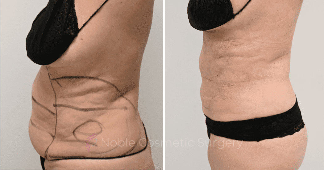 LIPOSUCTION-CASE-10145 | Before and After Liposuction 2