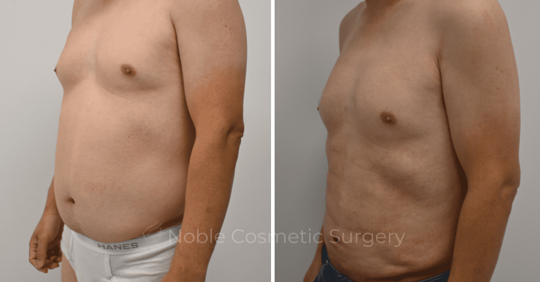 LIPOSUCTION-ABDOMEN-CASE-12252 | Before and After Male Liposuction 4