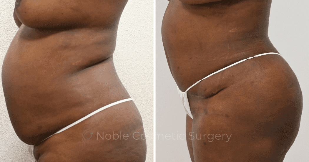 TUMMY-TUCK-CASE-13477 | Before and After Abdominoplasty 3