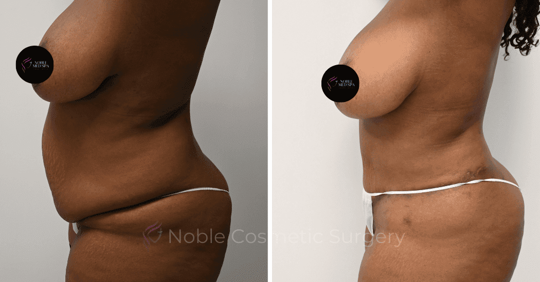 TUMMY-TUCK-CASE-14435 | Before and After Abdominoplasty 5