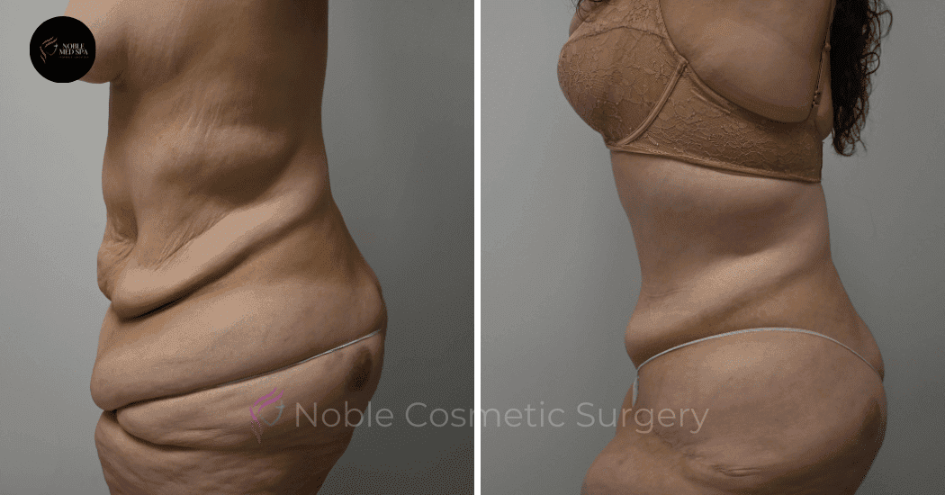 TUMMY-TUCK-CASE-10950 | Before and After Abdominoplasty 5