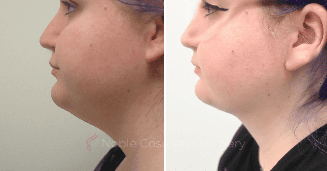 LIPOSUCTION-SUBMENTAL-CASE-19114 | Before and After Chin Liposuction 2