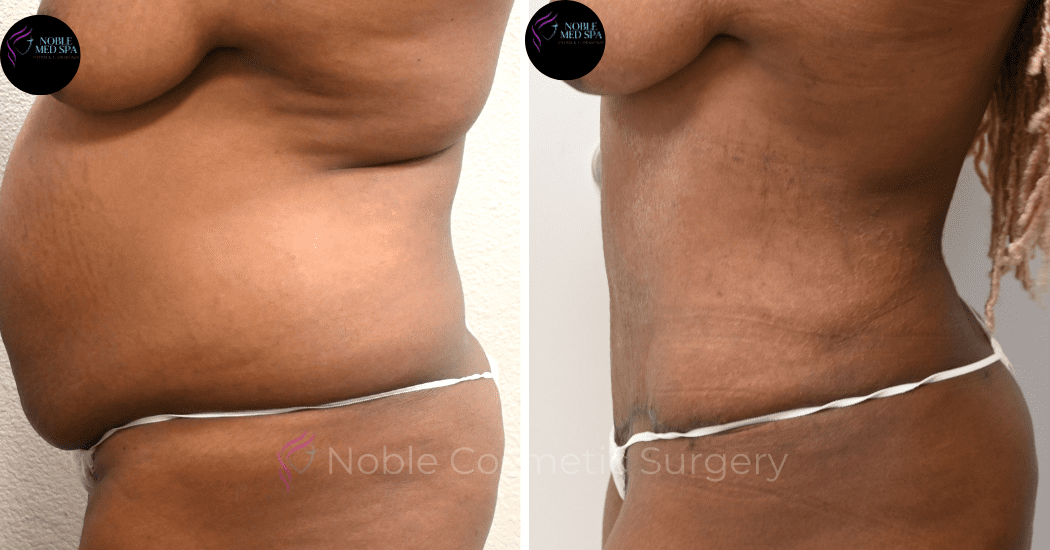 TUMMY-TUCK-CASE-13859 | Before and After Abdominoplasty 5