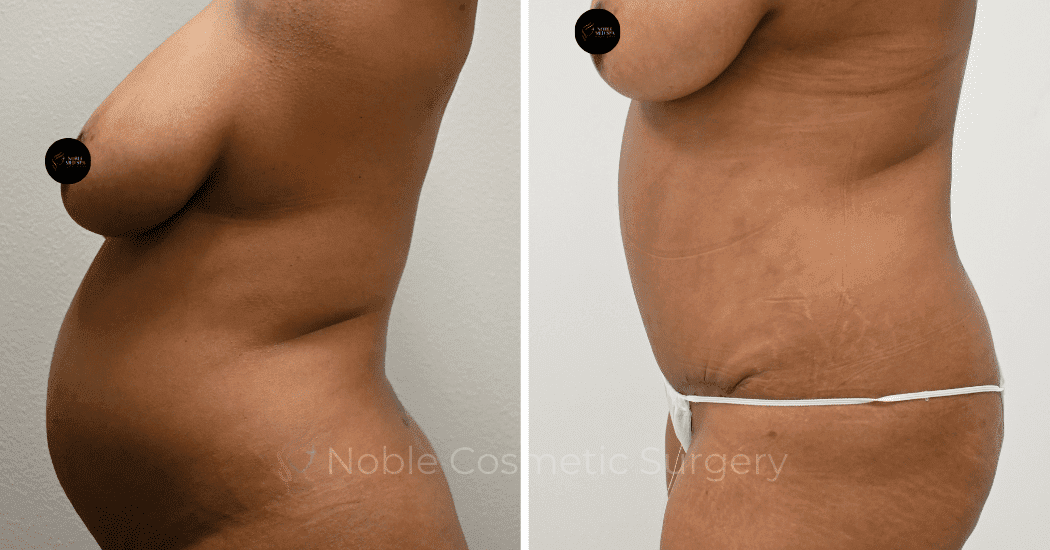 TUMMY-TUCK-CASE-14407 | Before and After Abdominoplasty 4