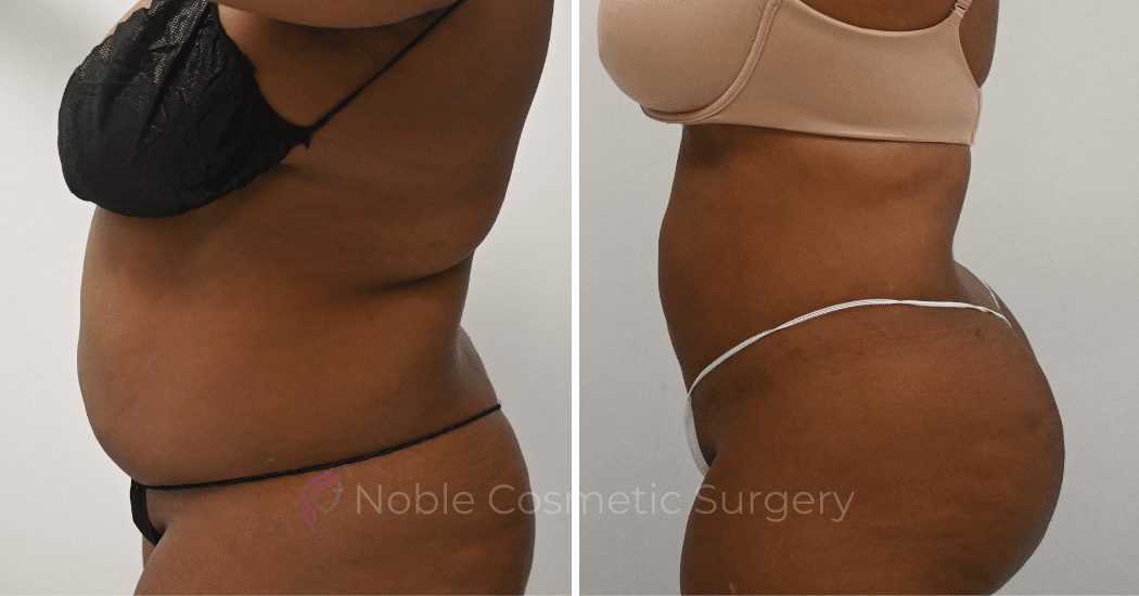 LIPOSUCTION-CASE-10271 | Before and After Liposuction 5