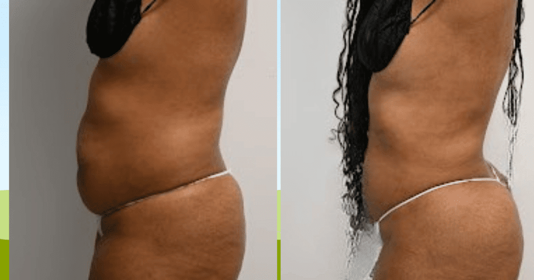 LIPOSUCTION-CASE-10929 | Before and After Liposuction 5