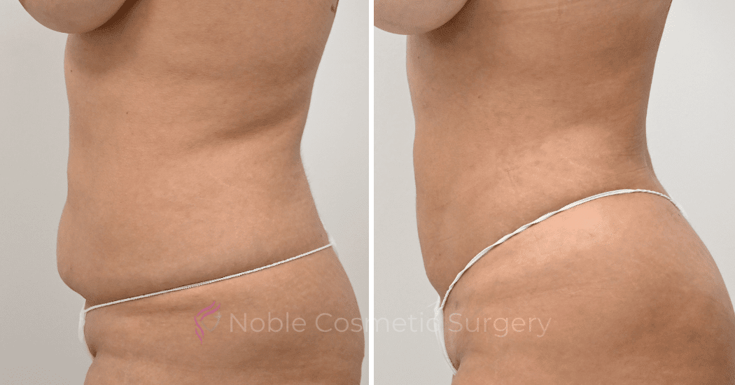 LIPOSUCTION-CASE-12977 | Before and After Liposuction 5