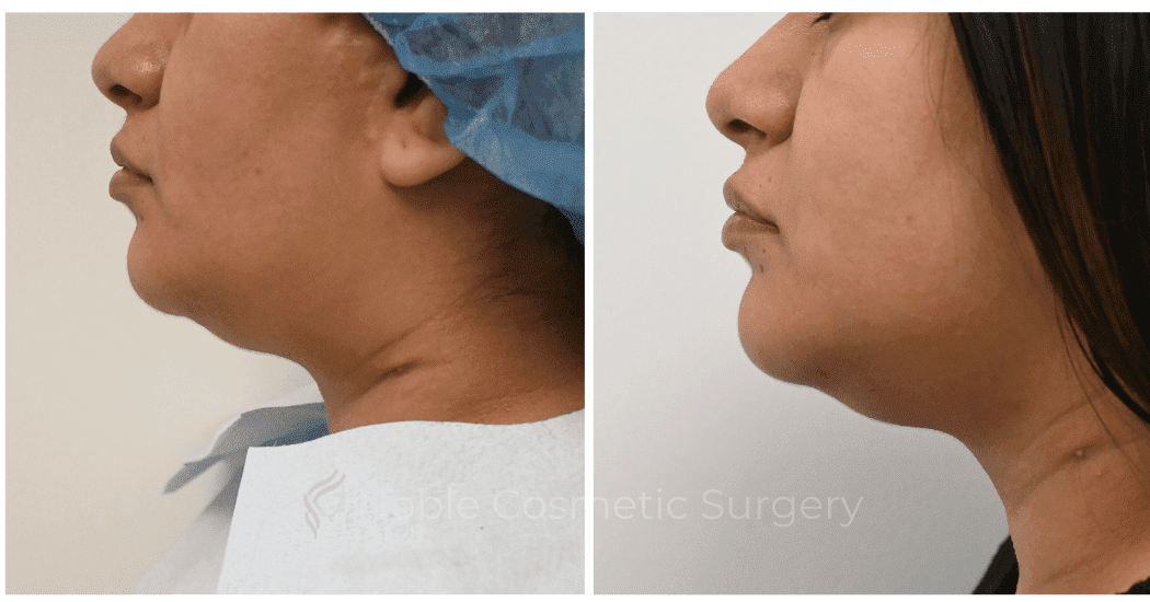 SUBMENTAL-LIPOSUCTION-CASE-10071 | Before and After Chin Liposuction 3
