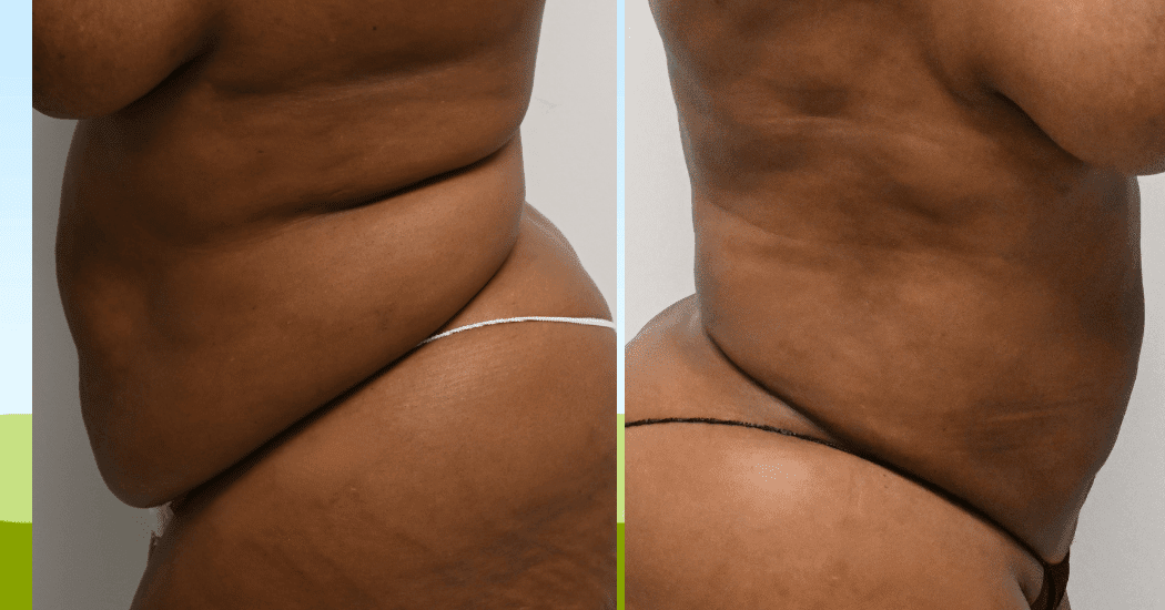 LIPOSUCTION-CASE-13371 | Before and After Liposuction 5