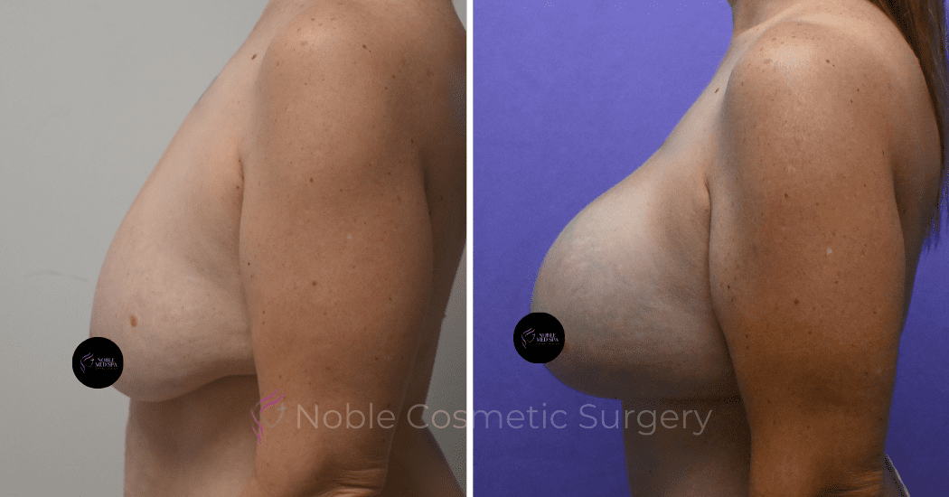 BREAST-AUGMENTATION-WITH-LIFT-CASE-10275 | Before and After Breast Augmentation with Lift 4