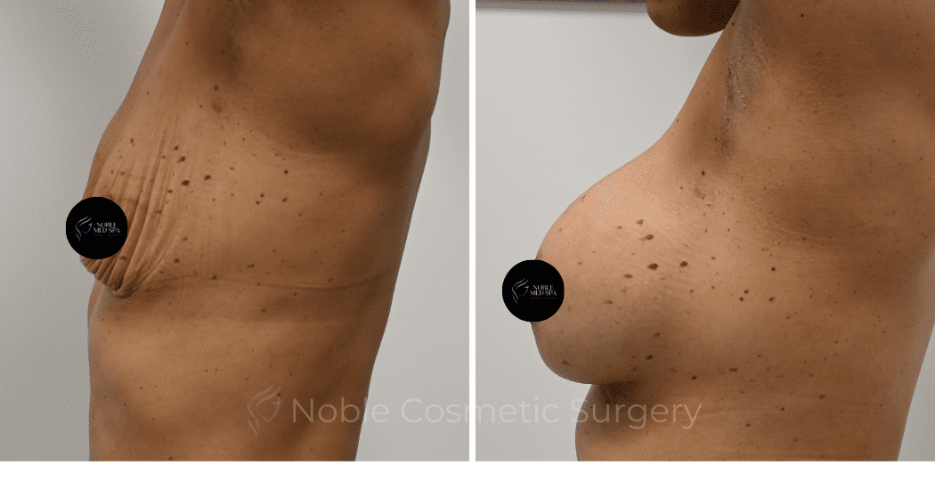 BREAST-AUGMENTATION-CASE-13021 | Before and After Breast Augmentation 4