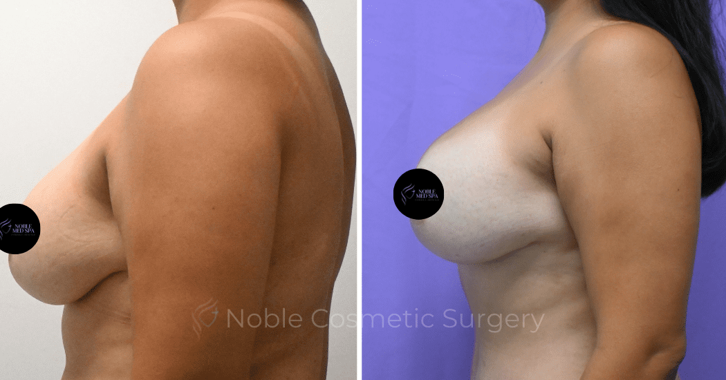 BREAST-AUGMENTATION--CASE-00310 | Before and After Breast Augmentation 5