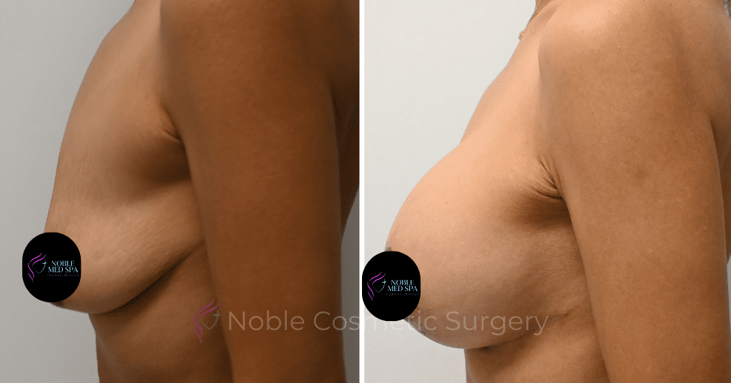 BREAST-AUGMENTATION-WITH-LIFT-CASE-10931 | Before and After Breast Augmentation with Lift 5