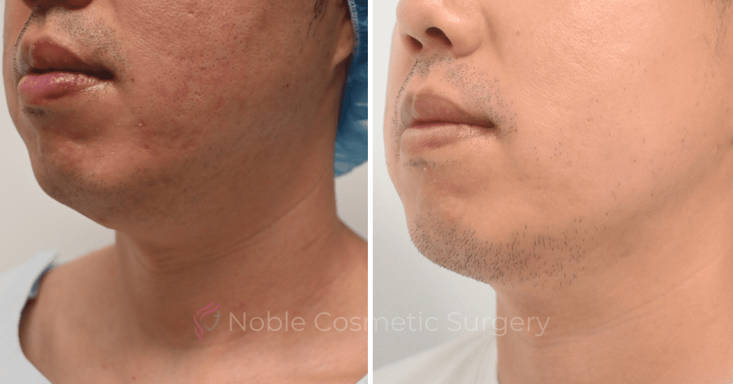 SUBMENTAL-LIPOSUCTION-CASE-10214 | Before and After Chin Liposuction 3