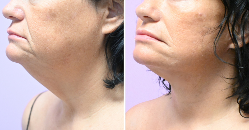 Case--5722 | Before and After Facelift 5