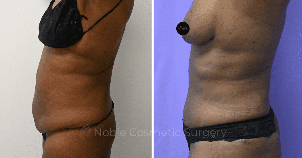 TUMMY-TUCK-CASE-10375 | Before and After Abdominoplasty 5