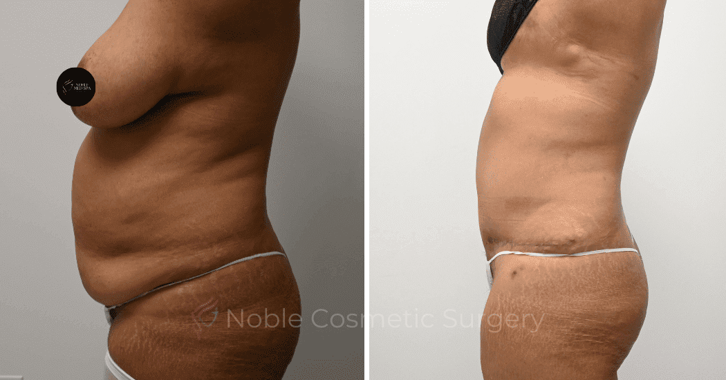 TUMMY-TUCK-CASE-11110 | Before and After Abdominoplasty 5