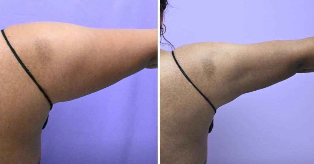Case--20274 | Before and After Arm Liposuction