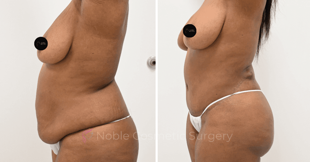 TUMMY-TUCK-CASE-13171 | Before and After Abdominoplasty 5